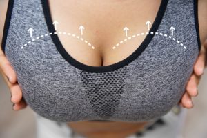 Surgical markings show where a breast reduction surgery will take place