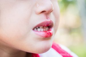 A close-up of a child's mouth with blood on their teeth and lips. You can see a teardrop on the side of the child's nose. 