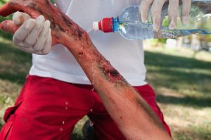 A person suffered a severe burn to the arm from a work accident.