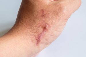Person with a scarred hand who may wish to use the scar compensation calculator for the UK