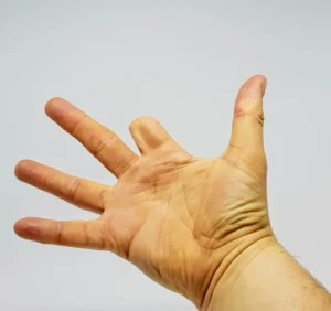 A picture of a person's hand missing their index finger.