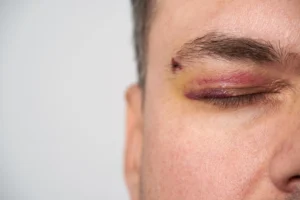 A man suffers a black eye and a mental injury after suffering a crime of violence.